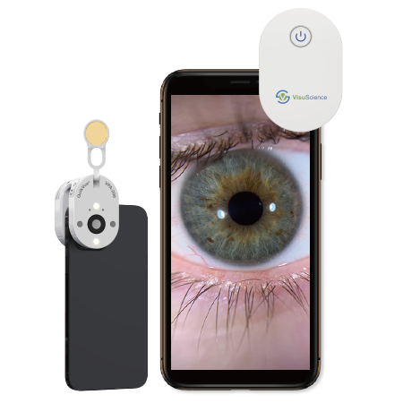 Scleral lens fitting with QuikVue adaptor